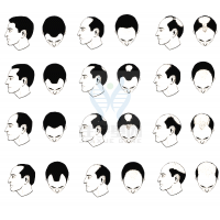 【贝斯特全球奢华基因检测】过早<font color='red'>脱发</font>、掉发太多怎么办？你的方法可能是错的！